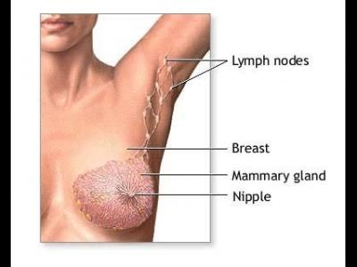 imagine cu cancerul mamar